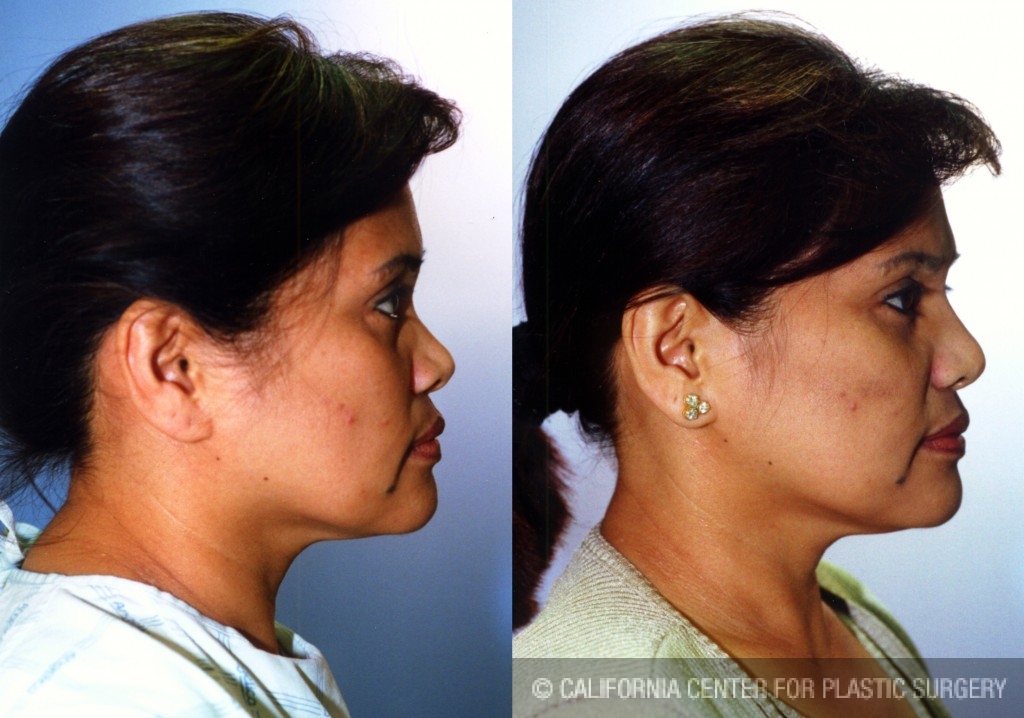Rhinoplasty - Asian Before & After Patient #6358