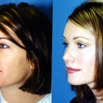 Rhinoplasty - Caucasian Before & After Patient #6184