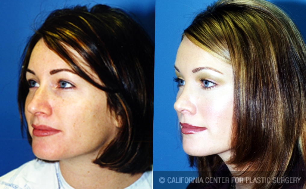 Rhinoplasty - Caucasian Before & After Patient #6184