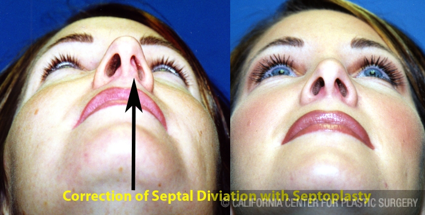 Rhinoplasty - Caucasian Before & After Patient #6184