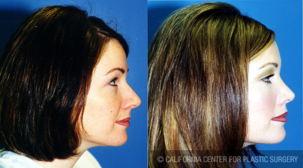 Rhinoplasty - Caucasian Before & After Patient #6184