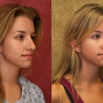 Rhinoplasty - Caucasian Before & After Patient #6190