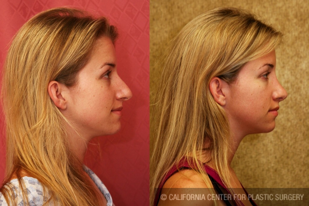 Rhinoplasty - Caucasian Before & After Patient #6190