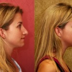 Rhinoplasty - Caucasian Before & After Patient #6190