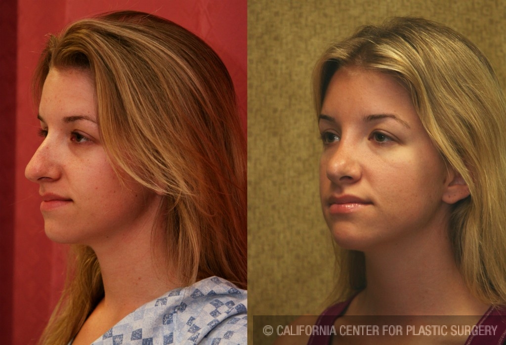 Rhinoplasty - Caucasian Before & After Patient #6190
