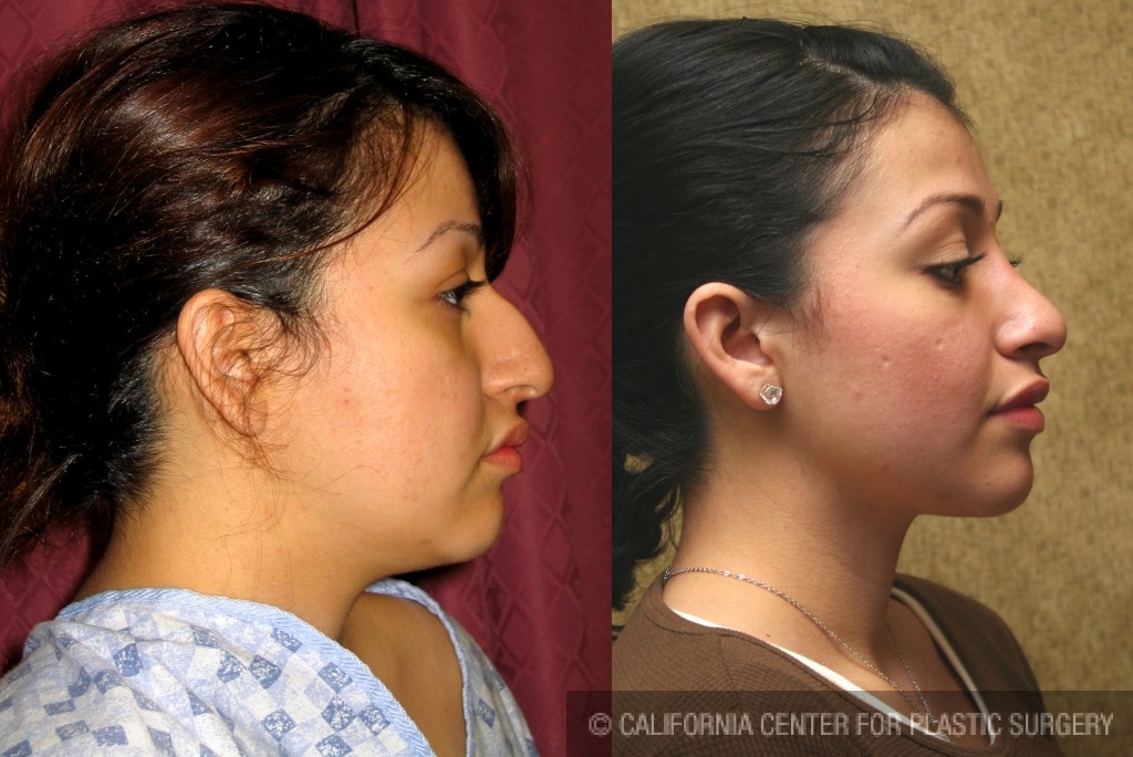 Rhinoplasty - Hispanic Before & After Patient #6272