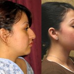 Rhinoplasty - Hispanic Before & After Patient #6272