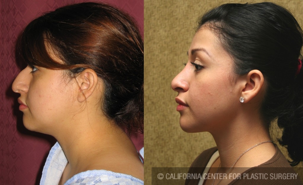 Rhinoplasty - Hispanic Before & After Patient #6272