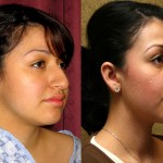 Rhinoplasty - Hispanic Before & After Patient #6272