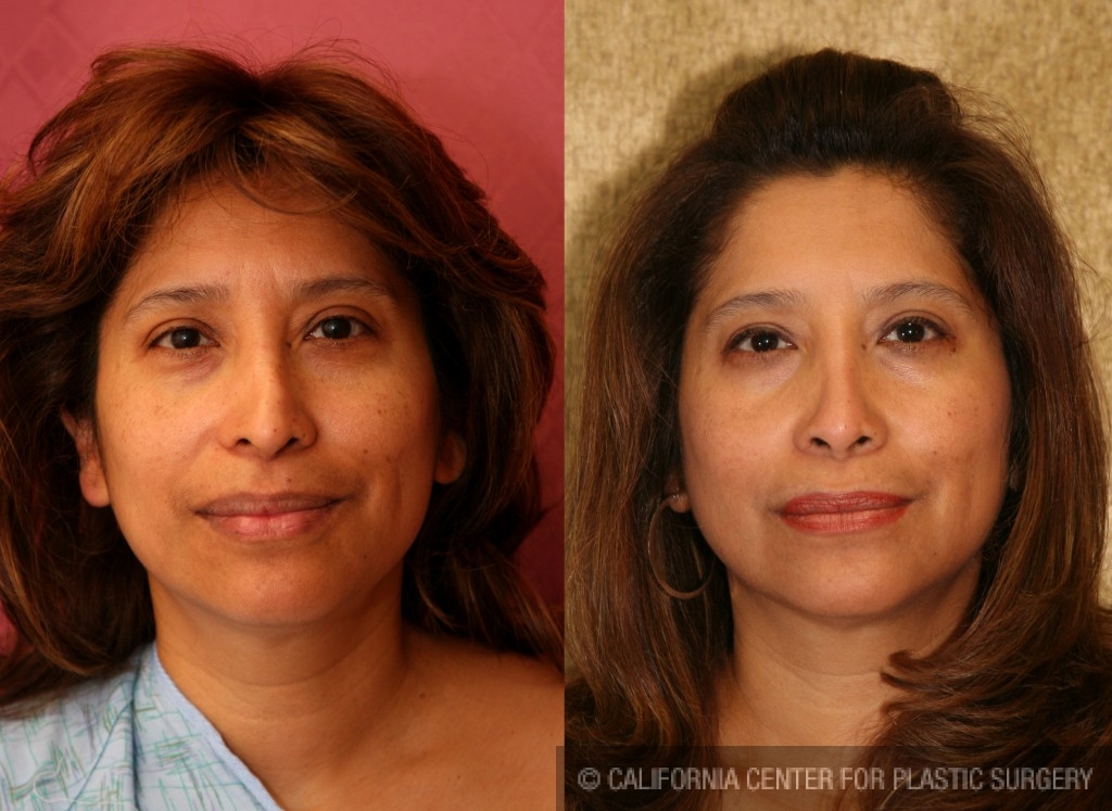 Rhinoplasty - Hispanic Before & After Patient #6284