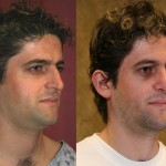 Male Rhinoplasty Before & After Patient #6424