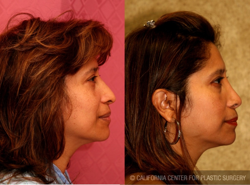 Rhinoplasty - Hispanic Before & After Patient #6284