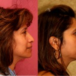 Rhinoplasty - Hispanic Before & After Patient #6284