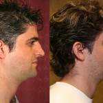 Male Rhinoplasty Before & After Patient #6424