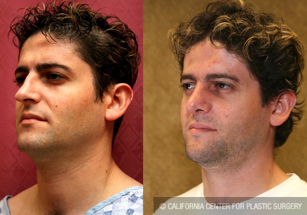 Male Rhinoplasty Before & After Patient #6424