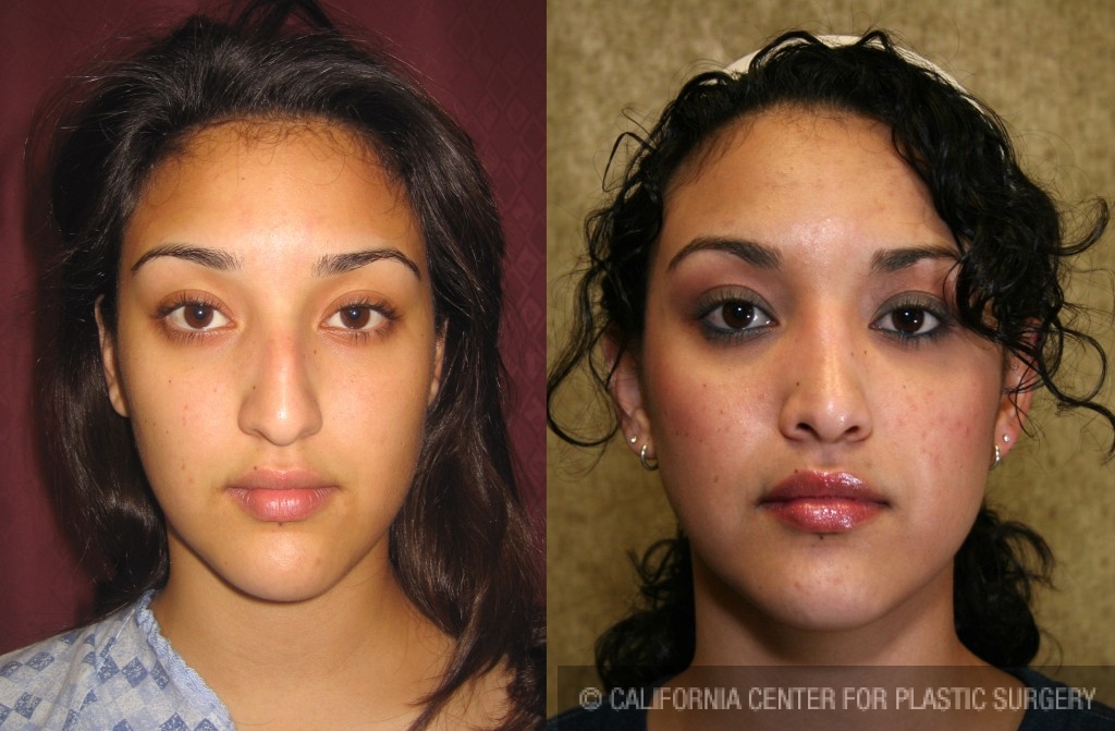 Rhinoplasty - Hispanic Before & After Patient #6264