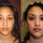 Rhinoplasty - Hispanic Before & After Patient #6264