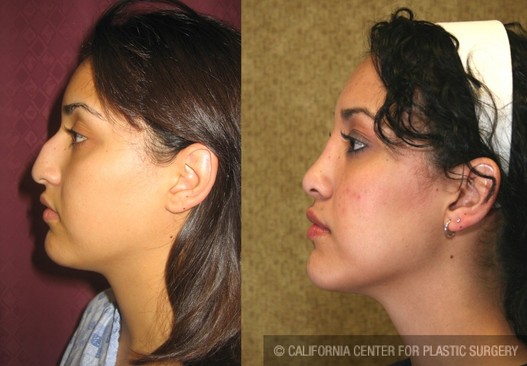 Rhinoplasty - Hispanic Before & After Patient #6264
