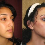 Rhinoplasty - Hispanic Before & After Patient #6264