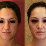 Rhinoplasty - Middle Eastern Before & After Patient #6347