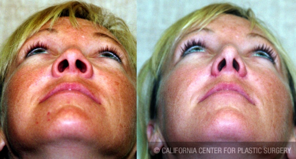 Rhinoplasty - Caucasian Before & After Patient #6247