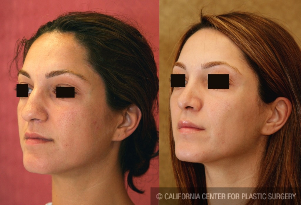 Rhinoplasty - Middle Eastern Before & After Patient #6347