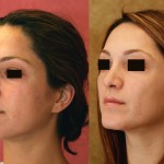Rhinoplasty - Middle Eastern Before & After Patient #6347