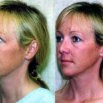 Rhinoplasty - Caucasian Before & After Patient #6247