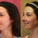 Rhinoplasty - Caucasian Before & After Patient #6201