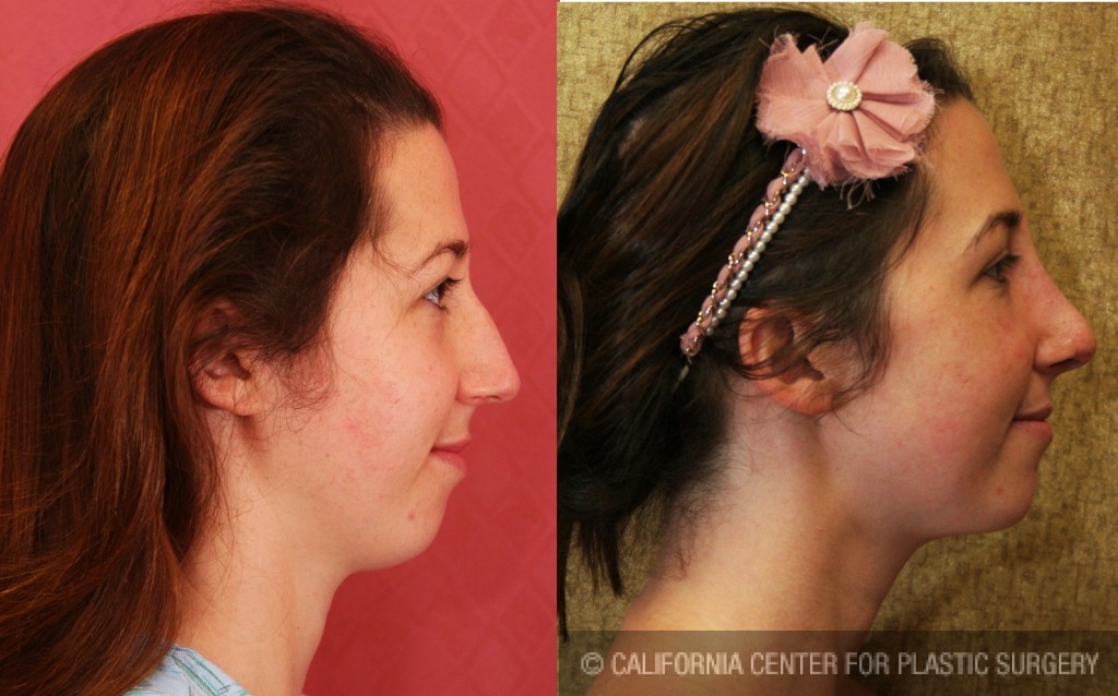 Rhinoplasty - Caucasian Before & After Patient #6201