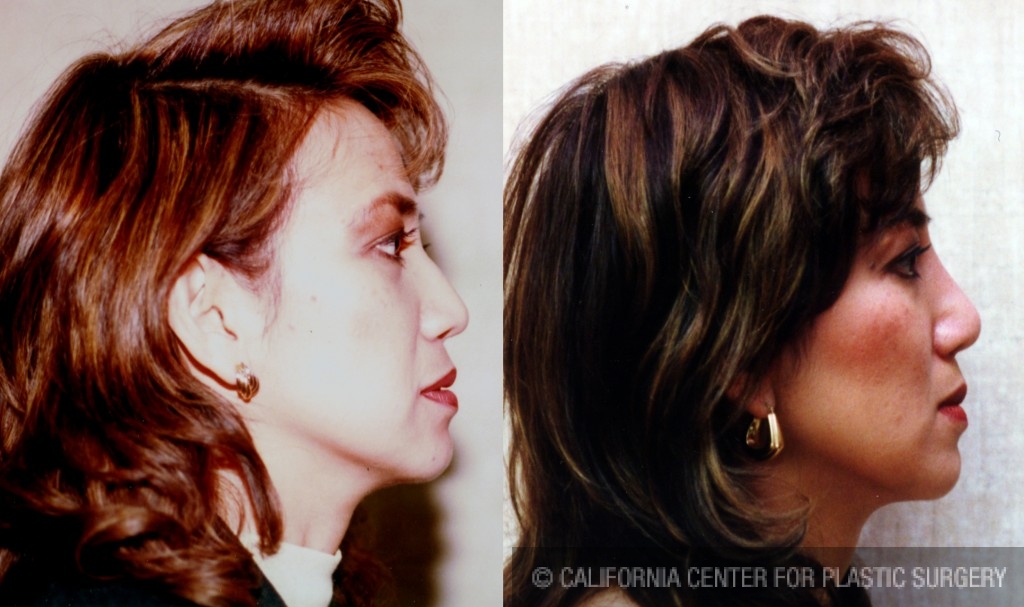 Rhinoplasty - Asian Before & After Patient #6385