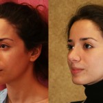 Rhinoplasty - Caucasian Before & After Patient #6196