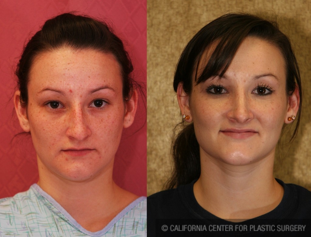 Rhinoplasty - Caucasian Before & After Patient #6214