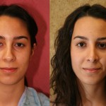 Rhinoplasty - Caucasian Before & After Patient #6224