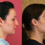 Rhinoplasty - Caucasian Before & After Patient #6214