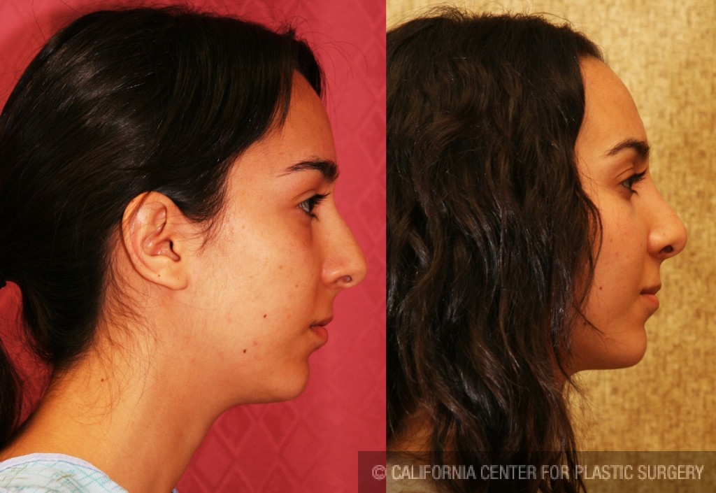 Rhinoplasty - Caucasian Before & After Patient #6224