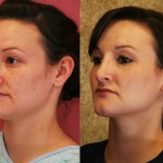 Rhinoplasty - Caucasian Before & After Patient #6214
