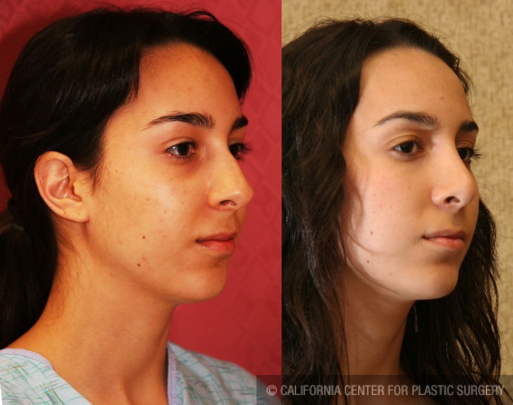 Rhinoplasty - Caucasian Before & After Patient #6224