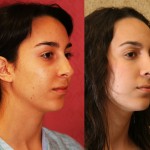 Rhinoplasty - Caucasian Before & After Patient #6224