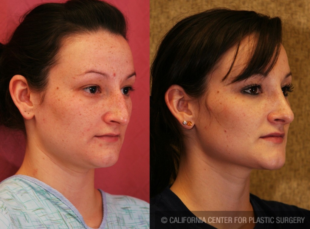 Rhinoplasty - Caucasian Before & After Patient #6214