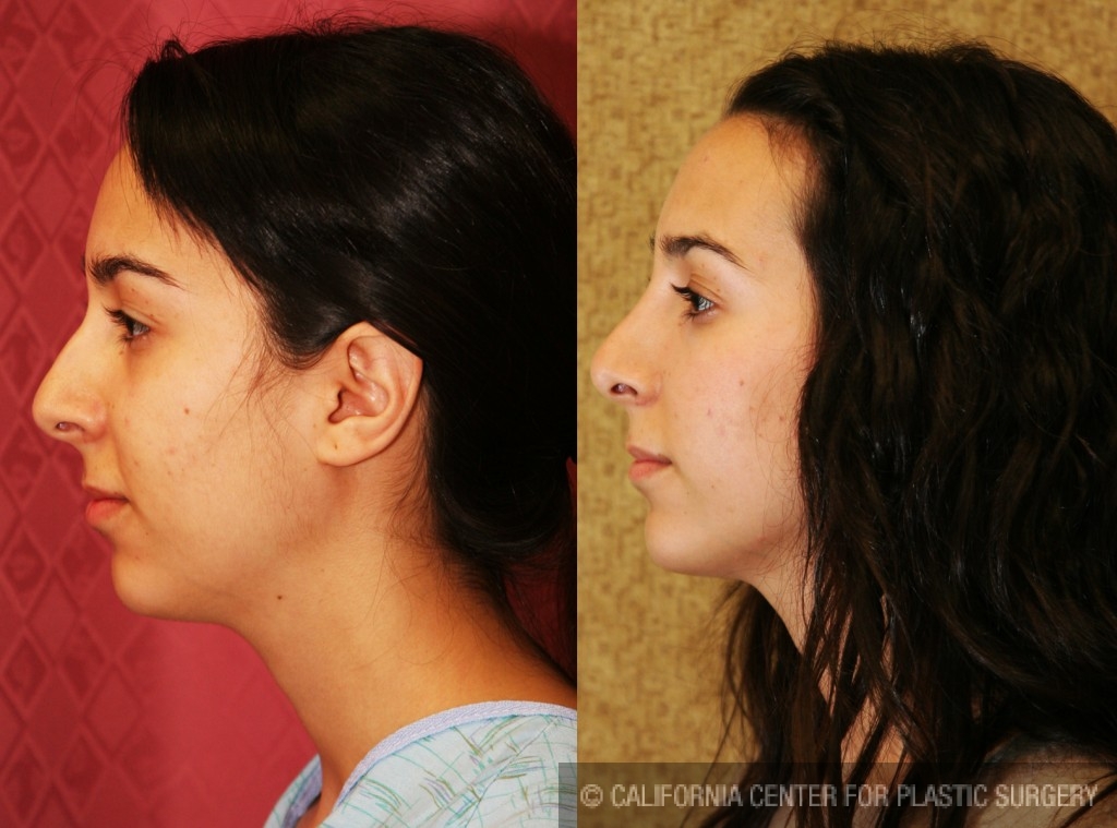 Rhinoplasty - Caucasian Before & After Patient #6224