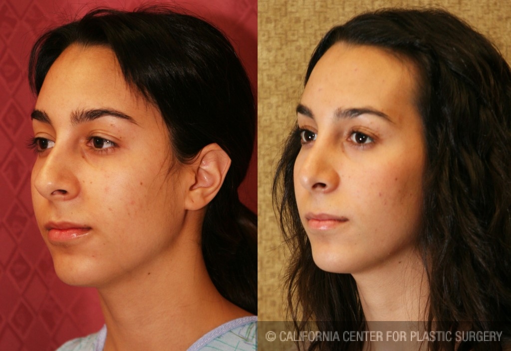 Rhinoplasty - Caucasian Before & After Patient #6224