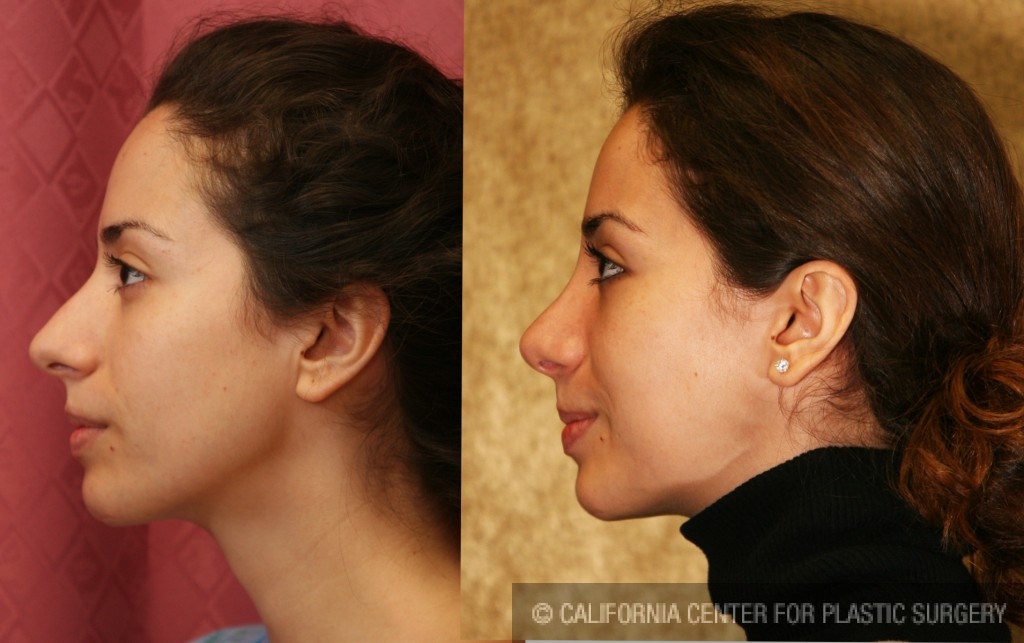 Rhinoplasty - Caucasian Before & After Patient #6196