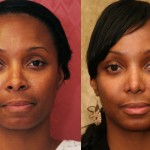 Rhinoplasty - African American Before & After Patient #6309