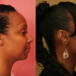 Rhinoplasty - African American Before & After Patient #6309