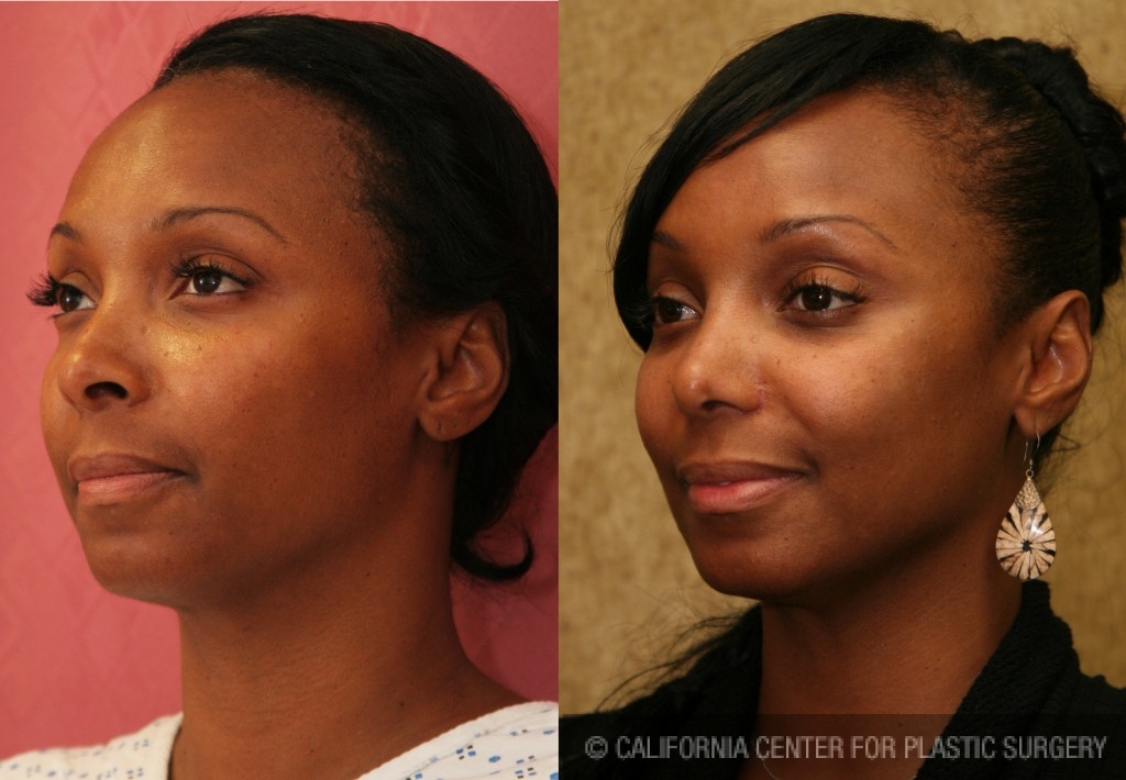 Rhinoplasty - African American Before & After Patient #6309