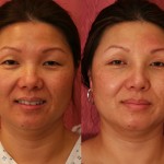 Rhinoplasty - Asian Before & After Patient #6375