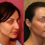 Rhinoplasty - Hispanic Before & After Patient #6255