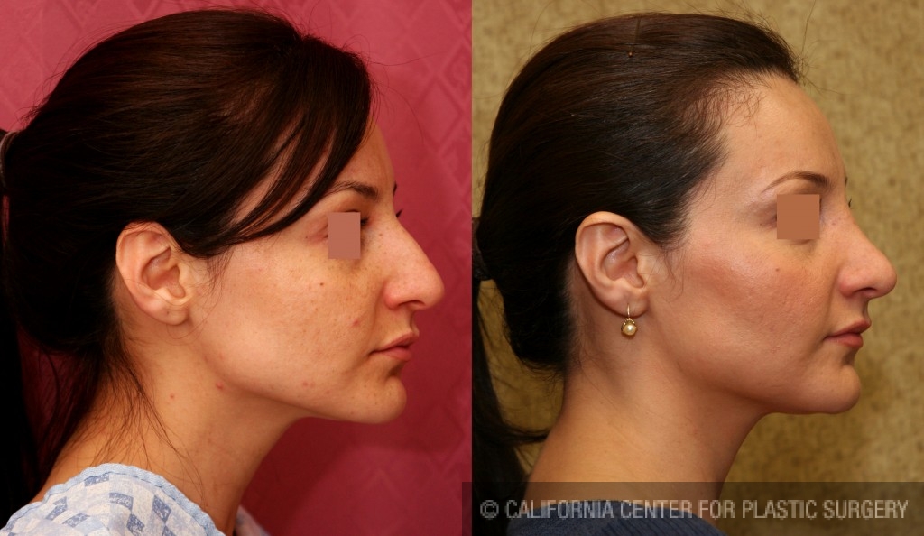 Rhinoplasty - Hispanic Before & After Patient #6255