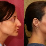 Rhinoplasty - Hispanic Before & After Patient #6255